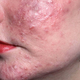 Illustration for article titled Rosacea could be caused by mites unleashing feces inside your pores